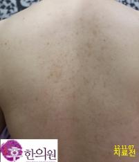 치료 전