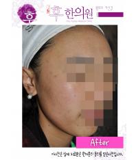 치료 후