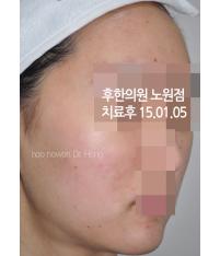 치료 후