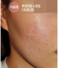 치료 후
