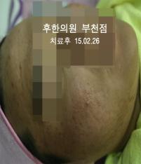 치료 후