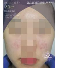 치료 후