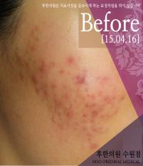 치료 전