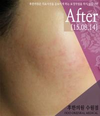 치료 후