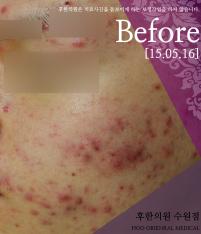 치료 전