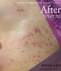 치료 후