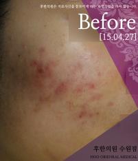 치료 전
