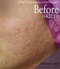 치료 전