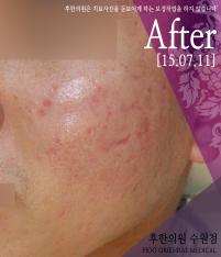 치료 후
