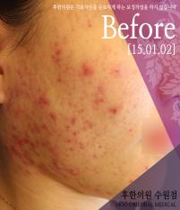 치료 전