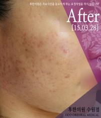 치료 후
