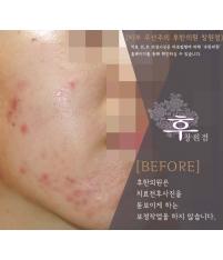 치료 전