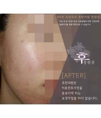 치료 후