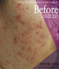 치료 전