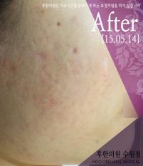 치료 후