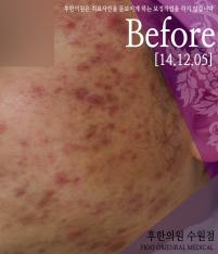 치료 전