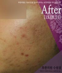 치료 후