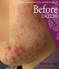 치료 전