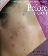 치료 전