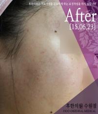 치료 후