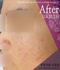 치료 후