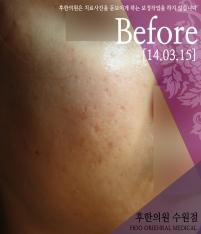 치료 전
