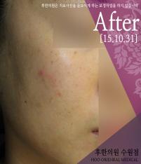 치료 후