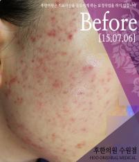 치료 전
