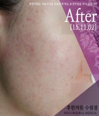 치료 후