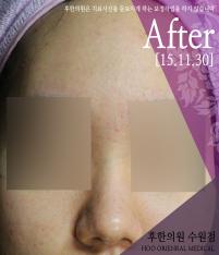 치료 후