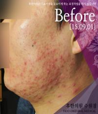 치료 전