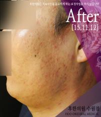 치료 후