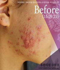 치료 전