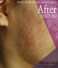 치료 후
