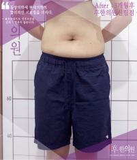 치료 후