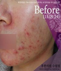치료 전