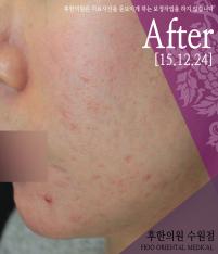 치료 후