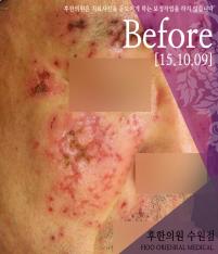 치료 전