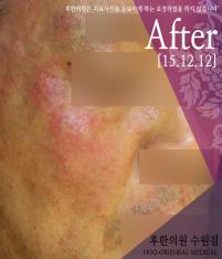 치료 후