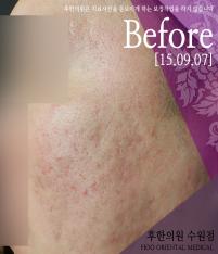 치료 전