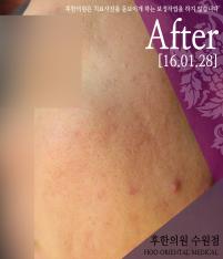 치료 후