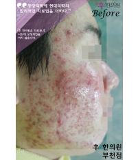 치료 전