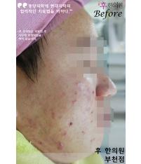 치료 전