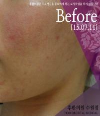치료 전