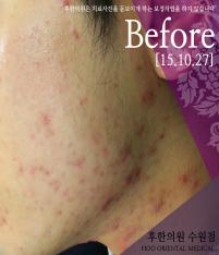 치료 전