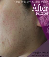 치료 후