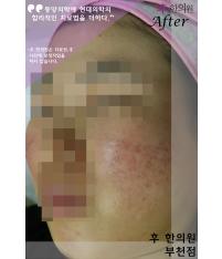 치료 후
