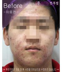 치료 전