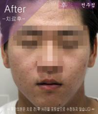 치료 후
