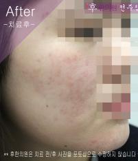 치료 후